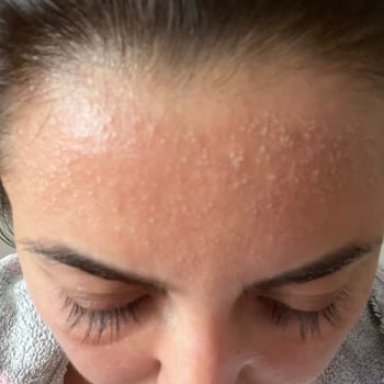 Bee Beauty Maske Sonrası Ciltte Şiddetli Alerjik Reaksiyon