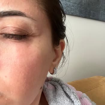 Bee Beauty Maske Sonrası Ciltte Şiddetli Alerjik Reaksiyon