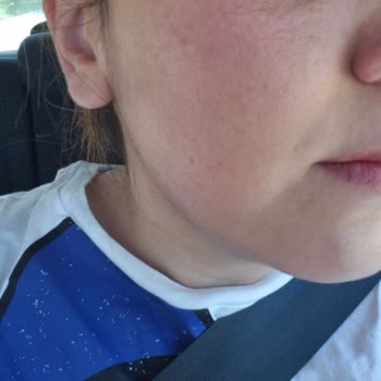 Royal Paris Güneş Kremi Sonrası Ciltte Kızarıklık Ve Leke Sorunu