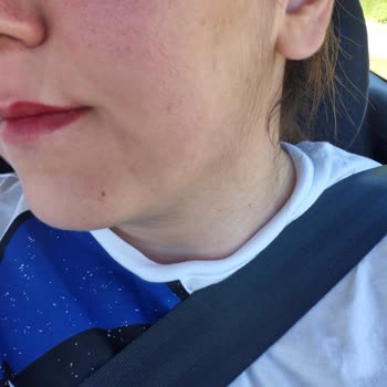 Royal Paris Güneş Kremi Sonrası Ciltte Kızarıklık Ve Leke Sorunu