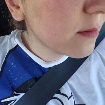 Royal Paris Güneş Kremi Sonrası Ciltte Kızarıklık Ve Leke Sorunu