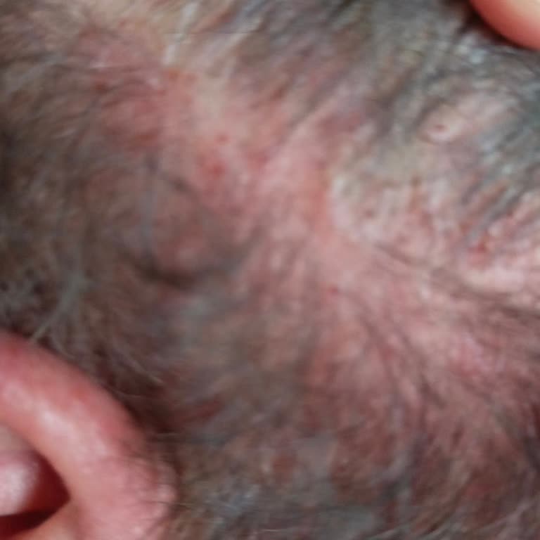 Saç Boyası Egzama Yaptı, Mağduriyetim Giderilmiyor