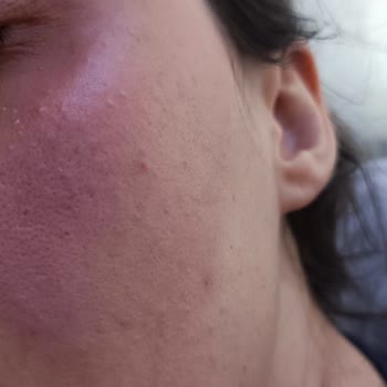 Eyüp Sabri Tuncer Yüze Sürülen Gül Suyu Ciltte Yanma Ve Kaşıntı Yaptı