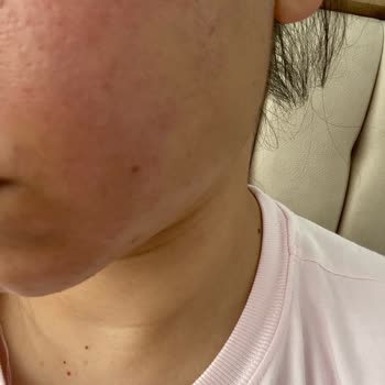 Yves Rocher Yüz Yıkama Jeli Cildimi Yaktı Ve Kızarıklık Yaptı