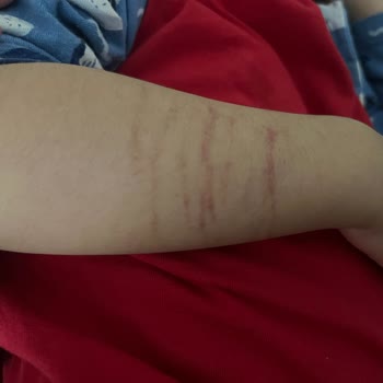 Acilde Yanlış Damar Yolu Uygulamasıyla Çocuğumun Kolu Zarar Gördü