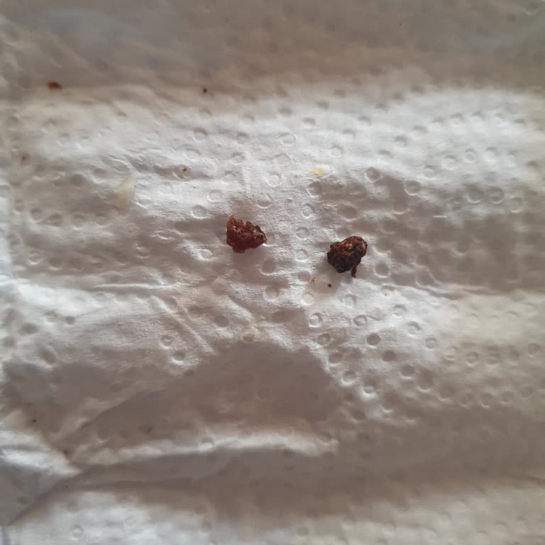 Uzman Kasap Dana Kıymadan Çıkan Yabancı Cisimler Diş Sağlığımı Tehlikeye Attı