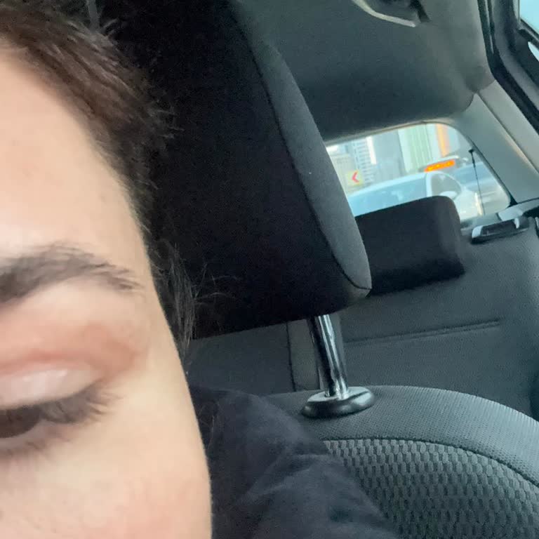 Göz Kapağı Ameliyatı Sonrası Kalıcı İz Ve İlgisiz Yaklaşım