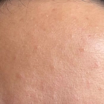 Vichy Serum Cildimi Mahvetti, Sivilce Ve Ağrı Yaptı