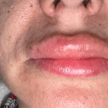 Dudak Dolgusu Sonrası Asimetri Ve İlgisizlik Mağduriyeti