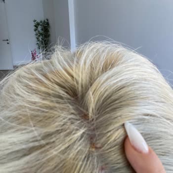 Saç Boyası Kullanımında Şiddetli Yanma Ve Deri Sorunları