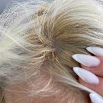 Saç Boyası Kullanımında Şiddetli Yanma Ve Deri Sorunları