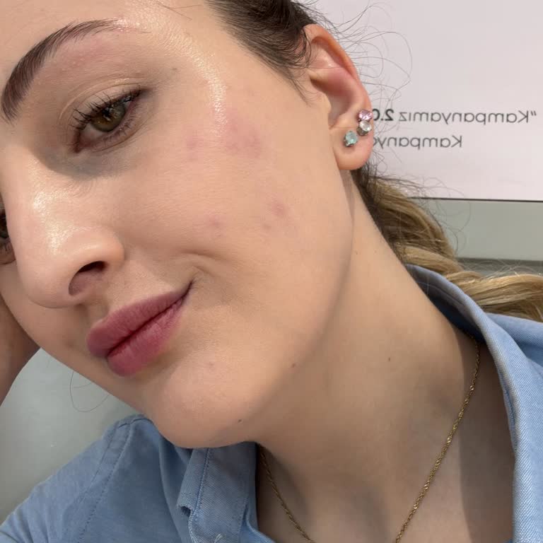 Mov Lip Tint from Gratis Caused Severe Allergic Reaction and Burned My Face