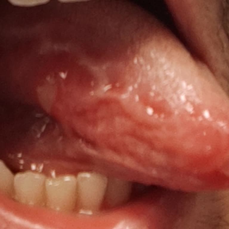 Parodontax Mouthwash Gave Me Painful Mouth Sores After Just Two Uses