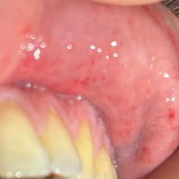 Parodontax Toothpaste Caused Severe Mouth Sores for Both Me and My Spouse