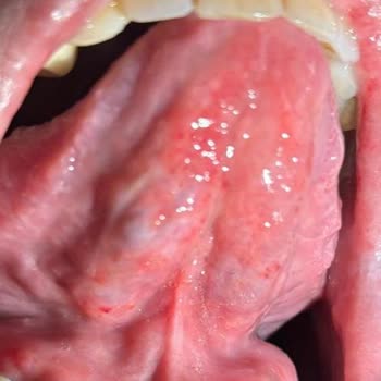 Parodontax Toothpaste Caused Severe Mouth Sores for Both Me and My Spouse