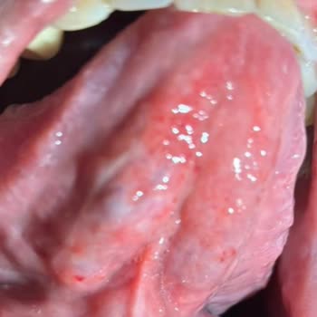 Parodontax Toothpaste Caused Severe Mouth Sores for Both Me and My Spouse