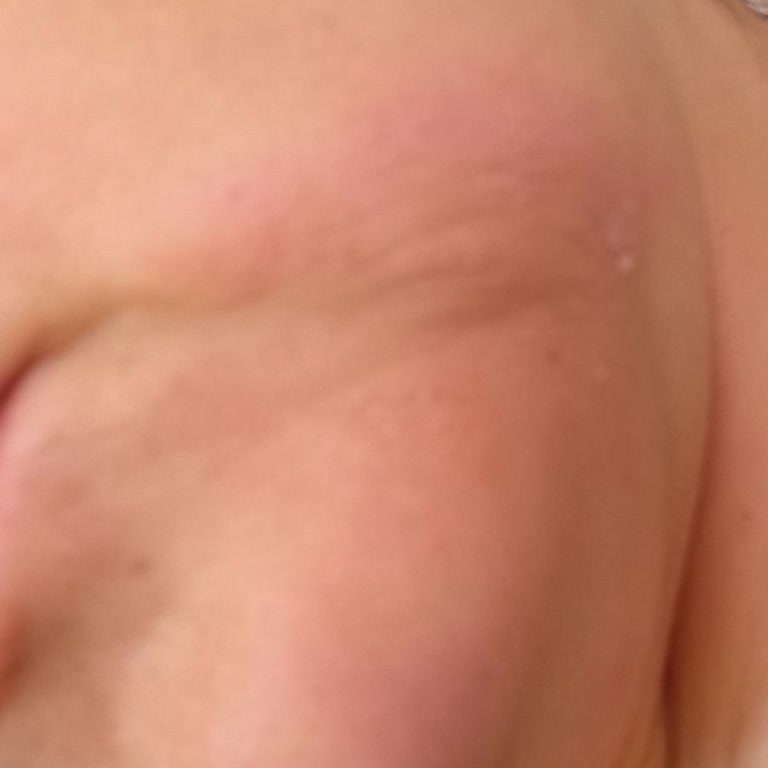 Loreal Göz Çevresi Ürünleri Cildimde Yanma Ve Kızarıklık Yaptı