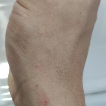 I Used Veet Men’s Hair Removal Cream and Got Severe Full-Body Allergic Reactions