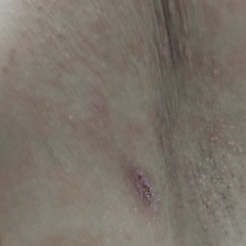 I Used Veet Men’s Hair Removal Cream and Got Severe Full-Body Allergic Reactions