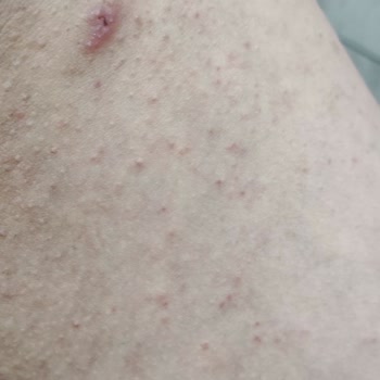 I Used Veet Men’s Hair Removal Cream and Got Severe Full-Body Allergic Reactions