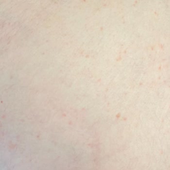 Meine schwangere Frau leidet unter Hautreaktion nach der Verwendung von Schwangerschaftscreme