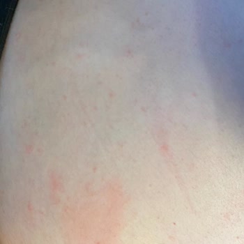 Meine schwangere Frau leidet unter Hautreaktion nach der Verwendung von Schwangerschaftscreme