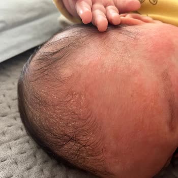 Mustela Konak-Shampoo hat Hautprobleme bei meinem Baby verursacht, Rötungen und Irritationen