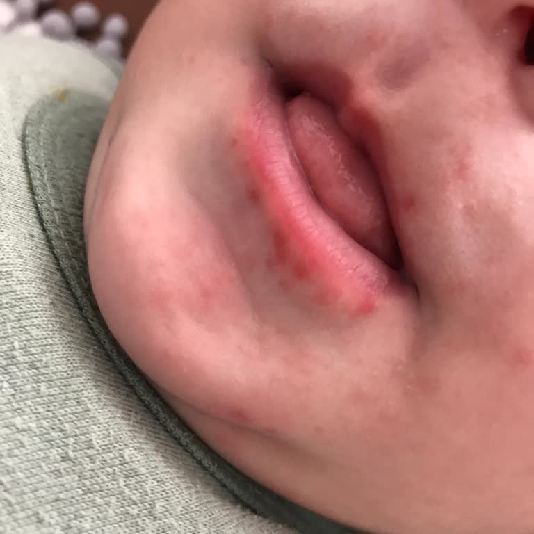 Mustela Stelatopia Creme hat bei meinem Baby eine schlimme Allergie verursacht