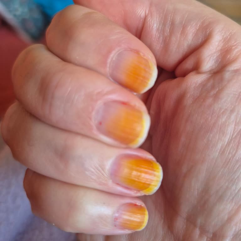 Pastel Oje Tırnakta Kalıcı Leke Bıraktı