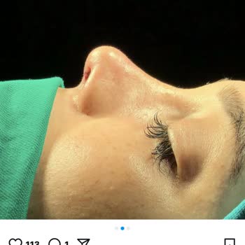 İkinci Burun Ameliyatı Sonrası Memnuniyetsizlik Ve Yetersiz Destek