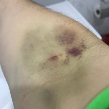 Türk Kızılay Kan Bağışında Yaşadığım Acı ve Morarma Sorunu