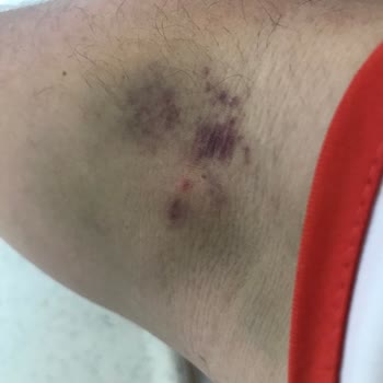 Türk Kızılay Kan Bağışında Yaşadığım Acı ve Morarma Sorunu