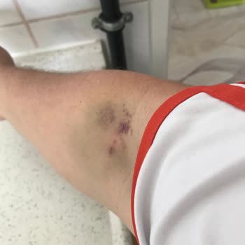 Türk Kızılay Kan Bağışında Yaşadığım Acı ve Morarma Sorunu