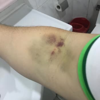 Türk Kızılay Kan Bağışında Yaşadığım Acı ve Morarma Sorunu