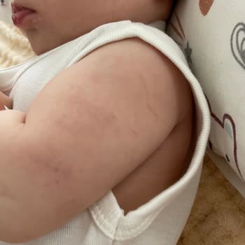 Bebeğimin Kolunda Morluk Ve Acı Veren Kan Alma Deneyimi