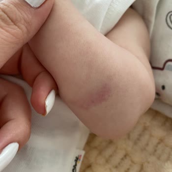 Bebeğimin Kolunda Morluk Ve Acı Veren Kan Alma Deneyimi