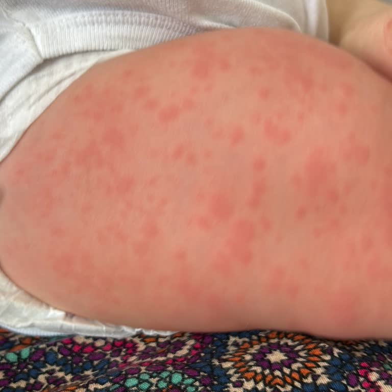 Enfluvir İlacının Yan Etkileri