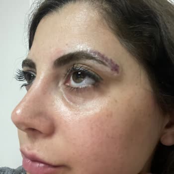 Kaş Silme İşlemi Sonrası Beklenmedik Ücretler Ve Kötü Sonuçlar Yaşadım