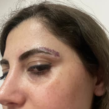 Kaş Silme İşlemi Sonrası Beklenmedik Ücretler Ve Kötü Sonuçlar Yaşadım