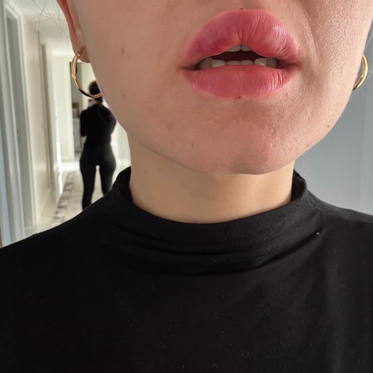 Dudak İşlemi Sonrası Asimetri Ve Çözüm Bulamama Deneyimi