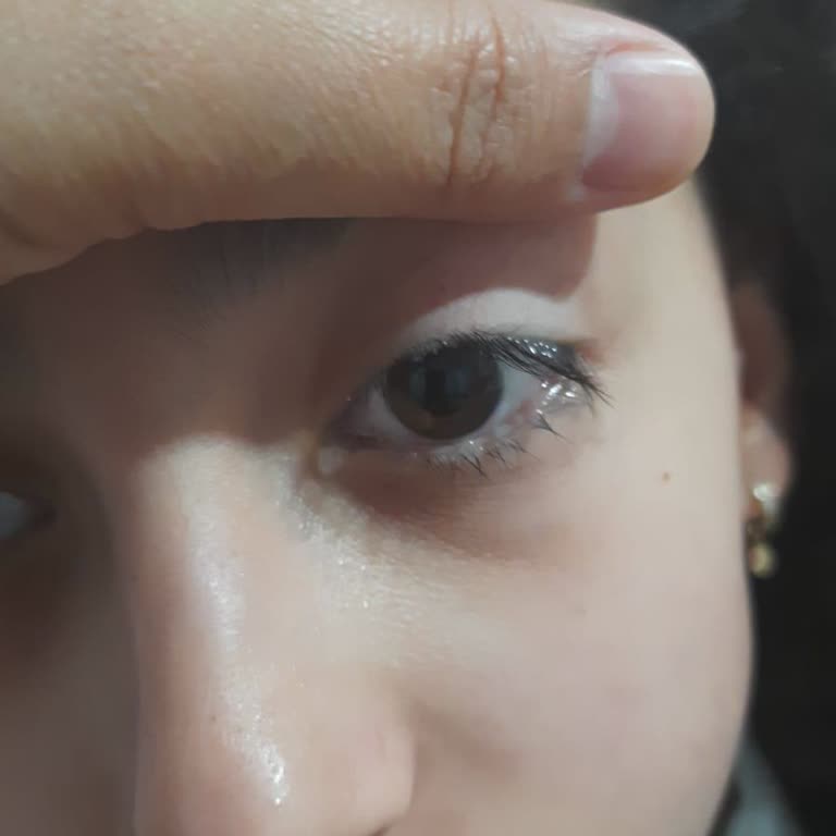 Acil Göz Enfeksiyonu İçin Yardım Alamayan Çocuğumun Mağduriyeti