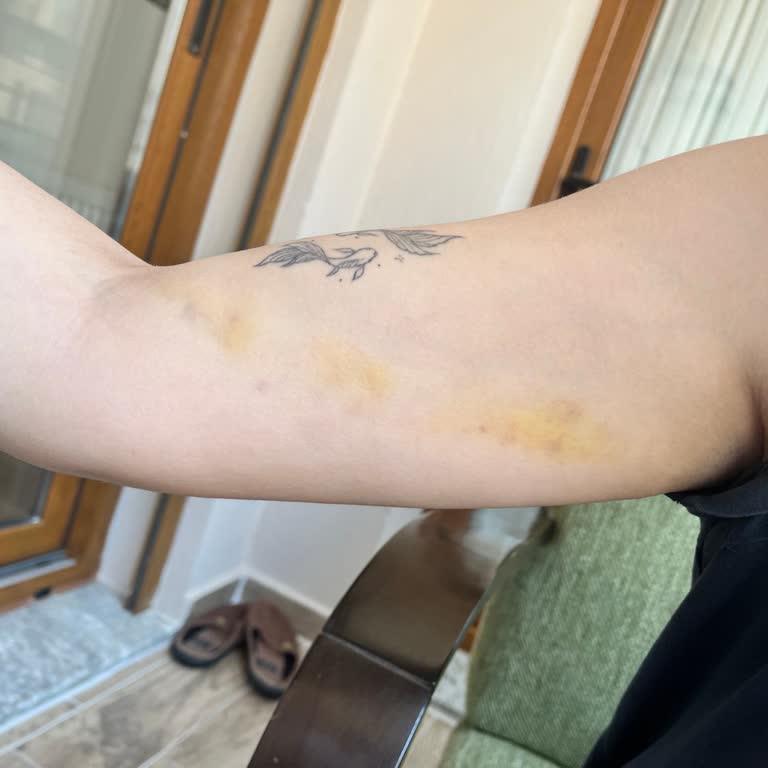 Serum Sonrası Kolumda Hasar Ve İlgisiz Hemşireler Nedeniyle Mağduriyet Yaşadım