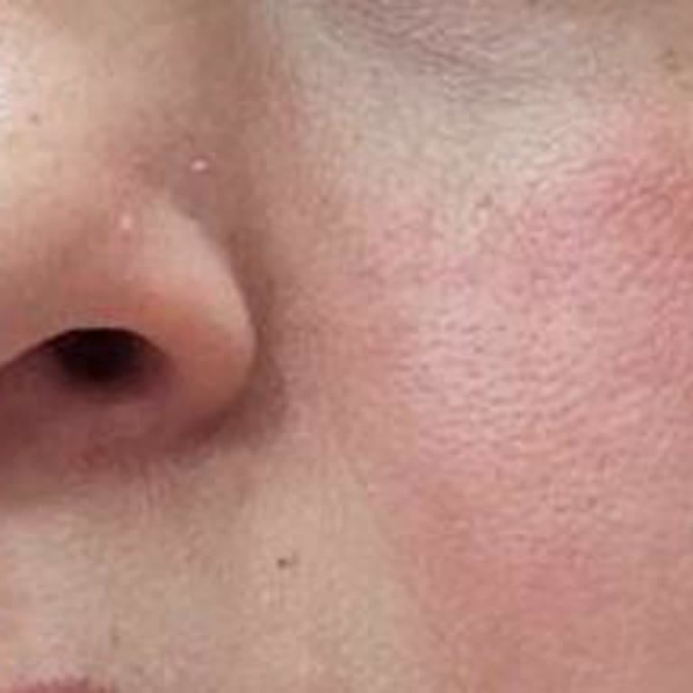 L'Loreal Paris Bright Reveal Cildimde Yanma Ve Kızarıklık Yaptı Müşteri Hizmetleri İlgisiz