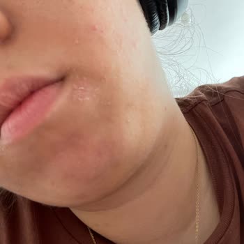 La Roche-Posay Effaclar Face Wash Caused Peeling Around My Nose and Lips