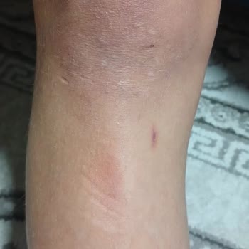 Onvo Scooter RX-5'te Güvenlik Sorunları Ve Yetersiz Servis Deneyimi