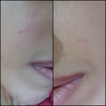 I Got Severe Breakouts After Using Sebamed Kompakt Cleansing Bar for Sensitive Skin