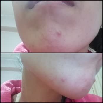 I Got Severe Breakouts After Using Sebamed Kompakt Cleansing Bar for Sensitive Skin