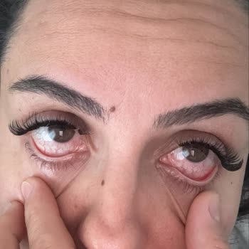 Yapıştırıcı Nedeniyle Gözümde Enfeksiyon Ve İlgisiz Hizmet