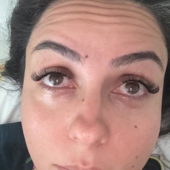 Yapıştırıcı Nedeniyle Gözümde Enfeksiyon Ve İlgisiz Hizmet