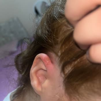 Aldığım Saç Boyası Ciddi Alerjik Reaksiyona Sebep Oldu